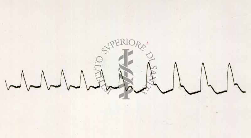 Pletismogramma dell'arteria temporale dell'uomo (azione dell'istamina)