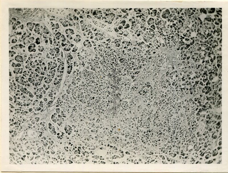 Pancreas - aree edermatose degenerative