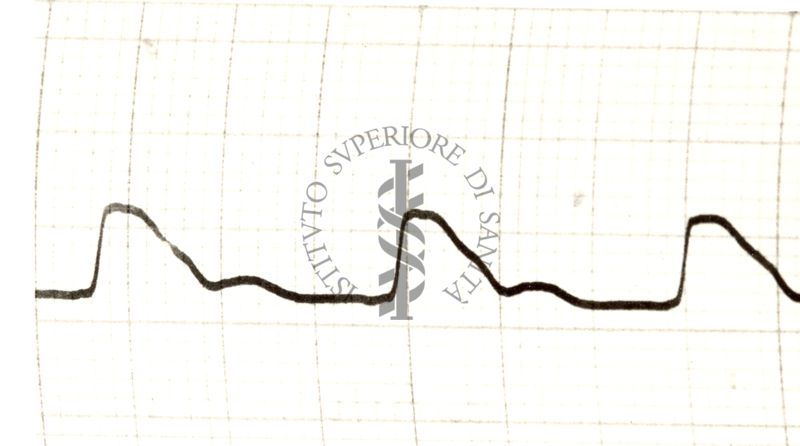 Azione del nitrito di amile sulla arteria temporale e radicale dell'uomo