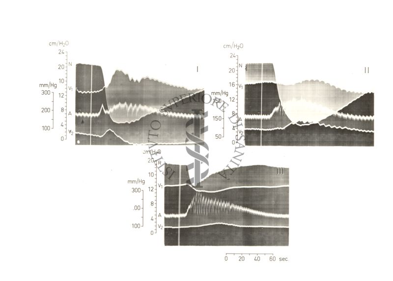 Grafico riguardante l'andrealina e circolo cerebrale