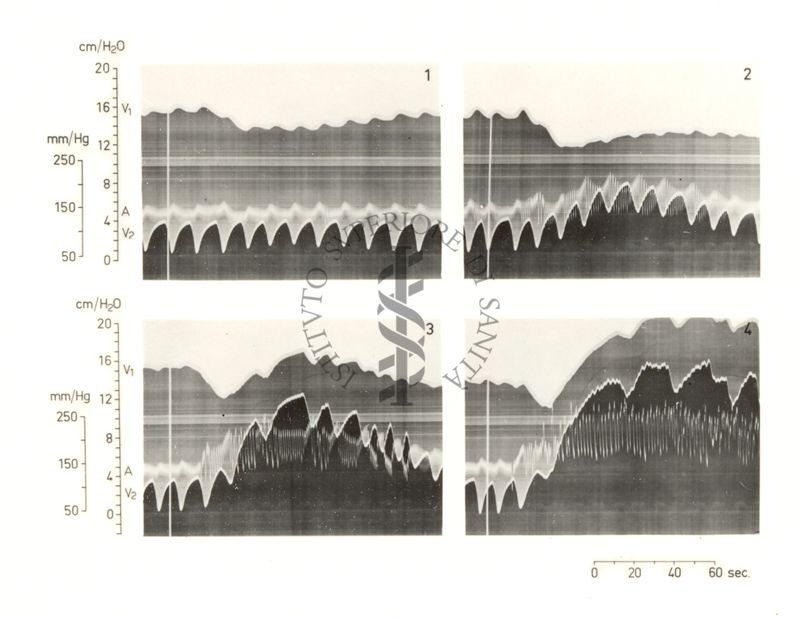 Grafico riguardante l'andrealina e circolo cerebrale