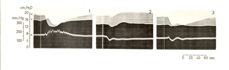 Grafico riguardante l'andrealina e circolo cerebrale