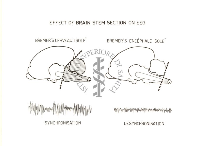 Effetti sull'E.E.G. del taglio praticato a vari livelli del tronco dell'encefalo