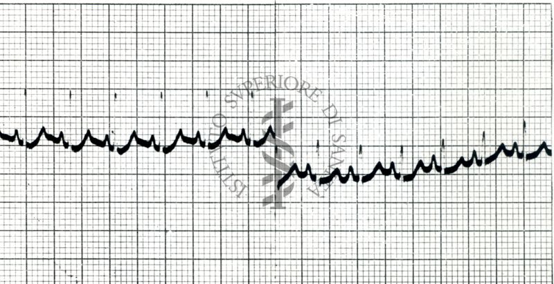 Curaro - Azione del Flaxedil su ECG del cane (2 mg/kg). 1 - ECG normale, 2 - dopo Flaxedil