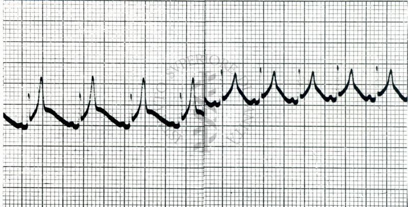 Curaro - Azione del Flaxedil su ECG del cane (sèguito della Negativa 6377 C). 1 - asfissia senza curaro, 2 - asfissia dopo Flaxedil