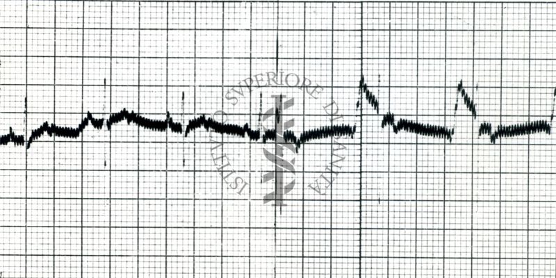 Curaro - Azione della Tubocurarina su ECG del cane (2 mg/kg). 1 - dopo Tubocurarina - 2 - dopo Flaxedil