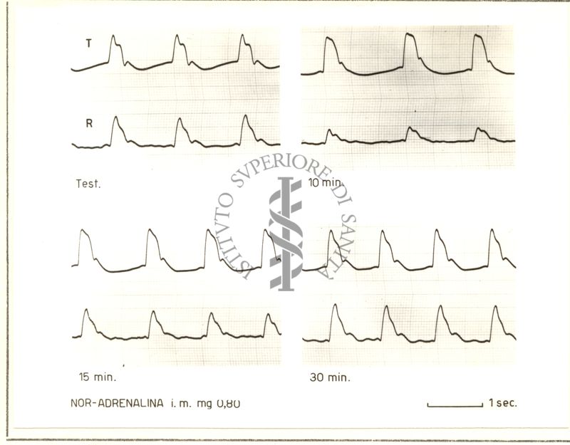 Polso temporale nell'uomo sotto azione di Noradrenalina: fotomontaggio di 4 grafici