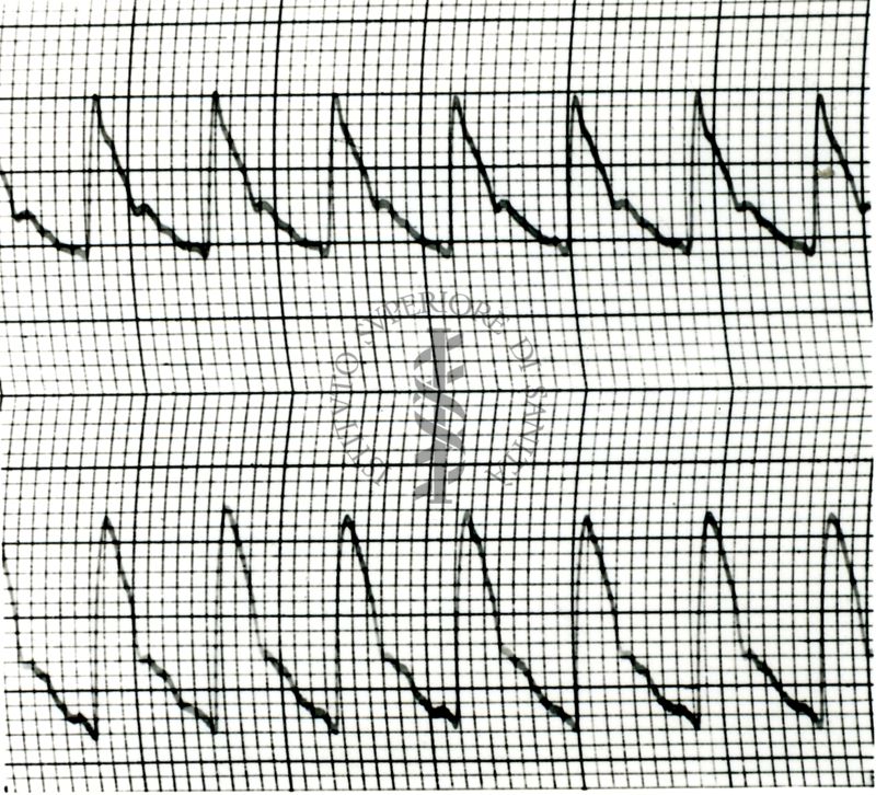 Piezosfigmogrammi di arterie temporali umane sotto attacchi emicranici