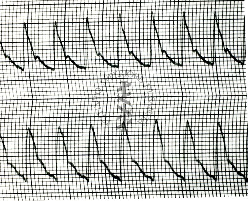 Piezosfigmogrammi di arterie temporali umane sotto attacchi emicranici