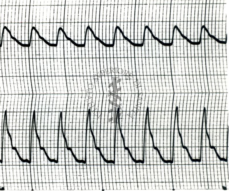 Piezosfigmogrammi di arterie temporali umane sotto attacchi emicranici