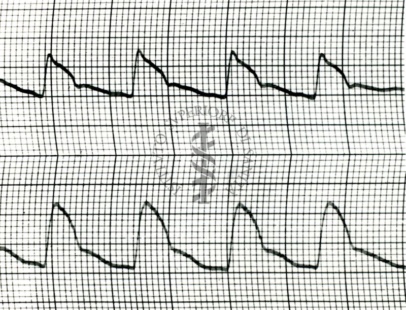 Piezosfigmogrammi di arterie temporali umane sotto attacchi emicranici