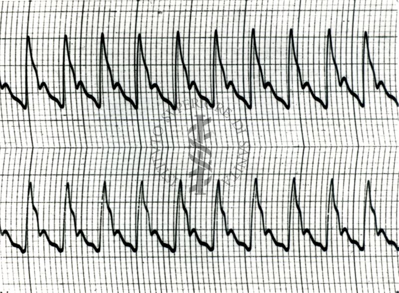 Piezosfigmogrammi di arterie temporali umane sotto attacchi emicranici