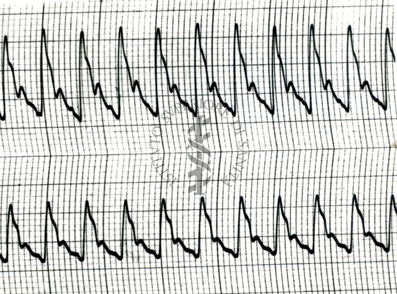 Piezosfigmogrammi di arterie temporali umane sotto attacchi emicranici