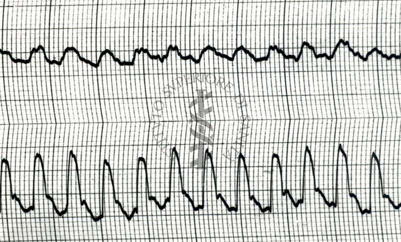 Piezosfigmogrammi di arterie temporali umane sotto attacchi emicranici