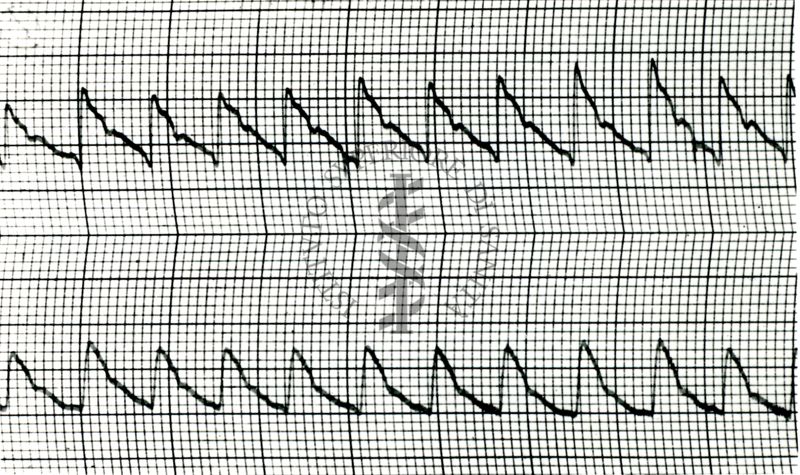 Piezosfigmogrammi di arterie temporali umane sotto attacchi emicranici