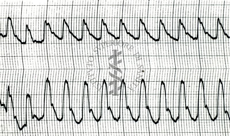 Piezosfigmogrammi di arterie temporali umane sotto attacchi emicranici