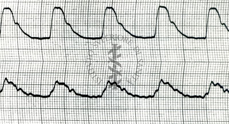 Piezosfigmogrammi di arterie temporali umane sotto attacchi emicranici