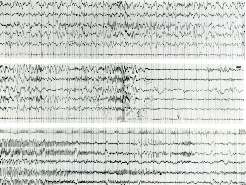 Tracciati elettroencefalografici di coniglio