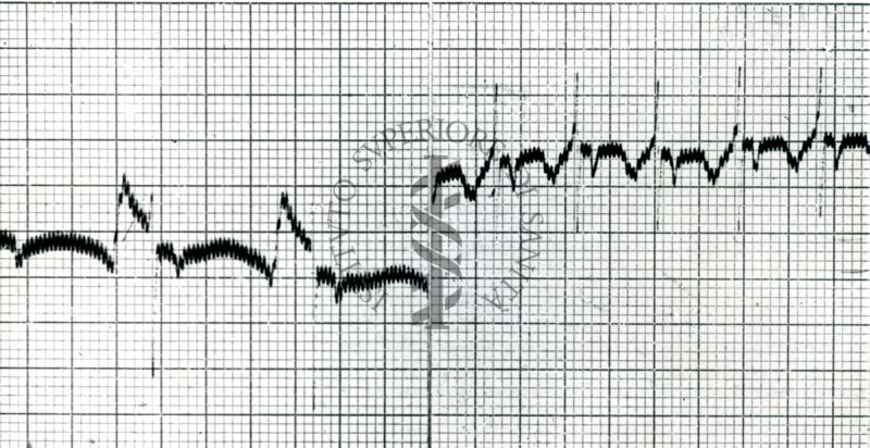 Curaro - Effetto dell'asfissia su ECG del cane normale. 1 - normale - 2 - dopo asfissia