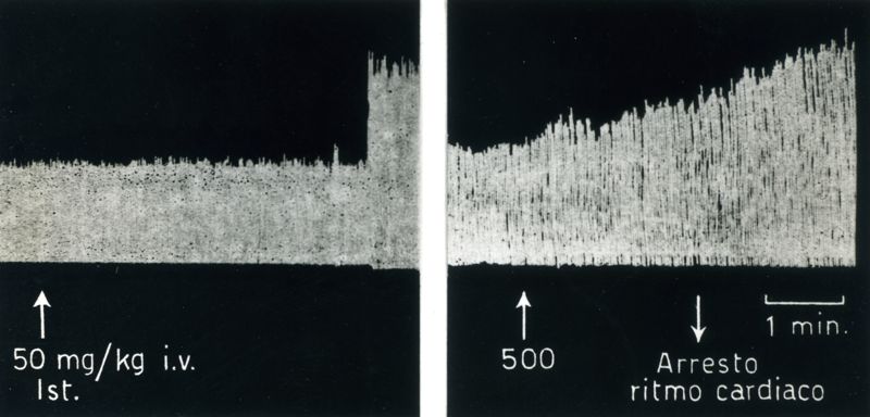 Tracciati broncografici riguardanti l'azione dell'Istamina