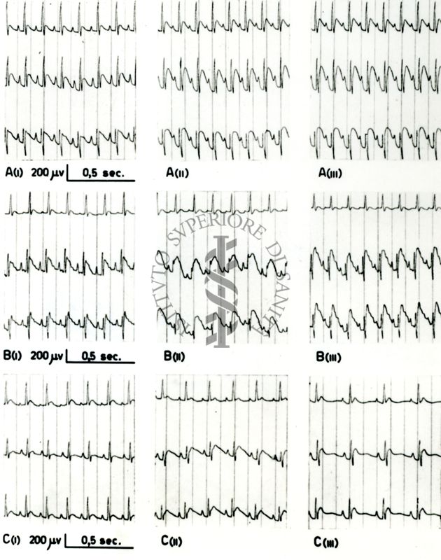 Tracciati broncografici riguardanti l'azione dell'Istamina