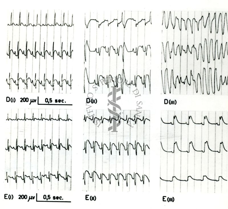 Tracciati broncografici riguardanti l'azione dell'Istamina