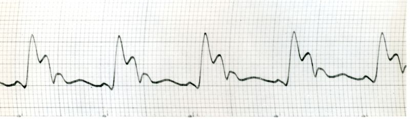 Sfigmogrammi dell'Aorta toracica