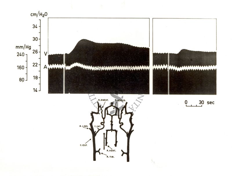 Circolo cerebrale - iniezioni intraarteriose