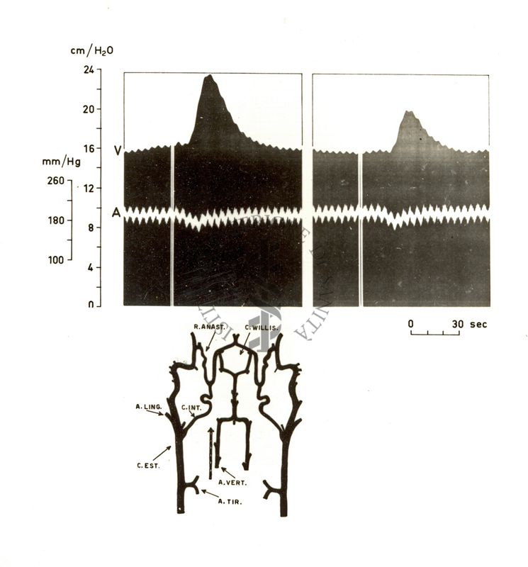 Circolo cerebrale - iniezioni intraarteriose