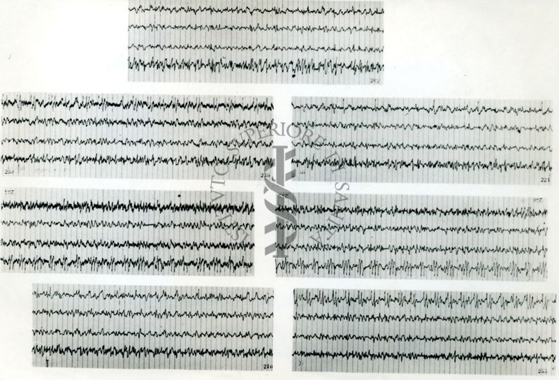 Rapporti tra circolazione cerebrale ed elettroncefalografia