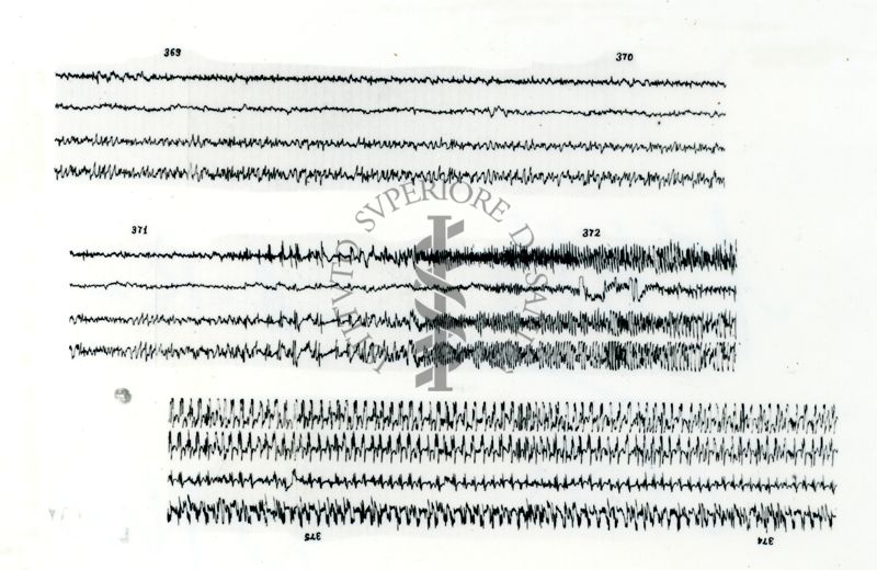 Azione elettroencefalografica della stricnina