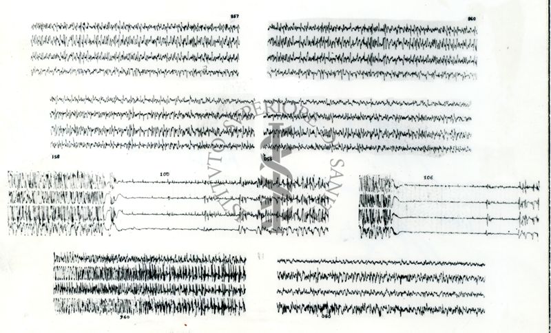 Azione elettroencefalografica della stricnina