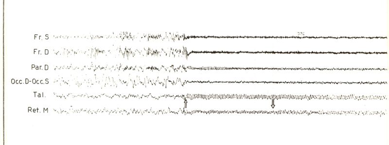 Tracciati elettroencefalografici