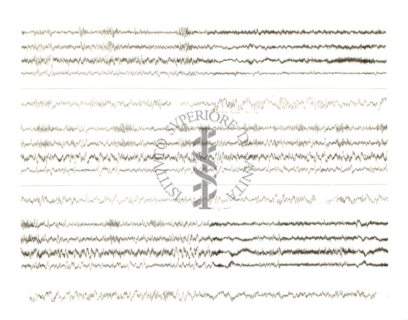 Tracciati elettroencefalografici