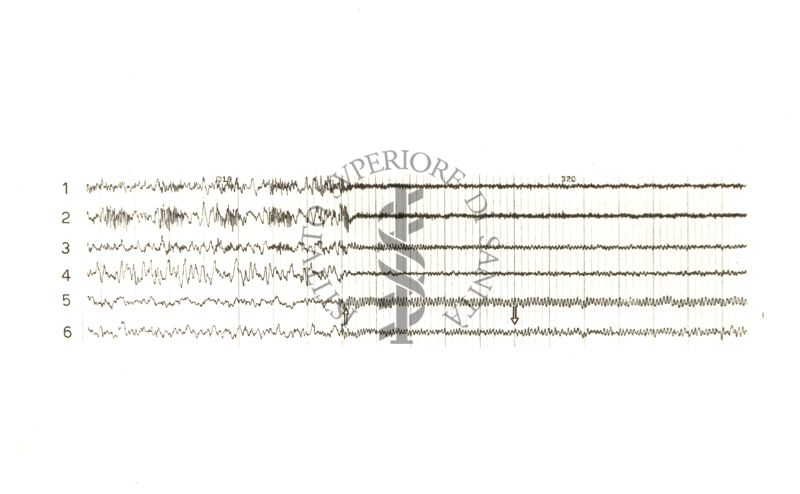 Tracciati elettroencefalografici