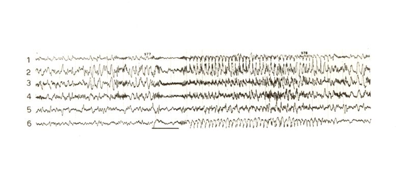 Tracciati elettroencefalografici