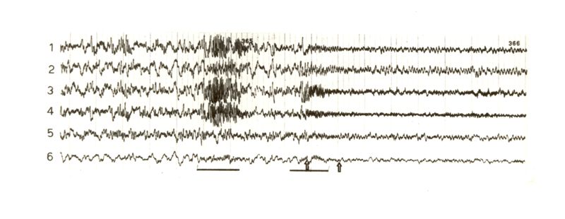 Tracciati elettroencefalografici