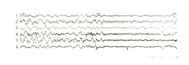 Tracciati elettroencefalografici