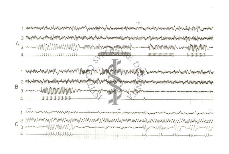 Tracciati elettroencefalografici