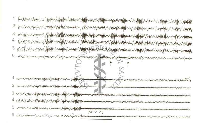 Tracciati elettroencefalografici