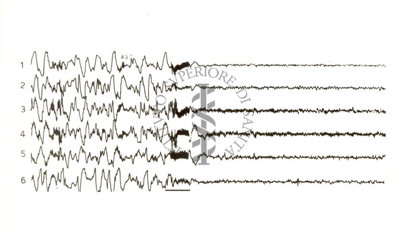 Tracciati elettroencefalografici