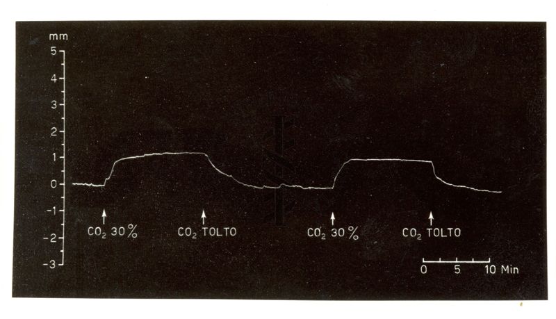 Edema cerebrale