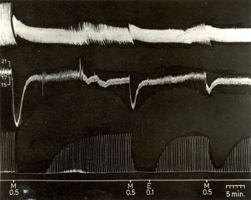 Tracciati elettroencefalografici