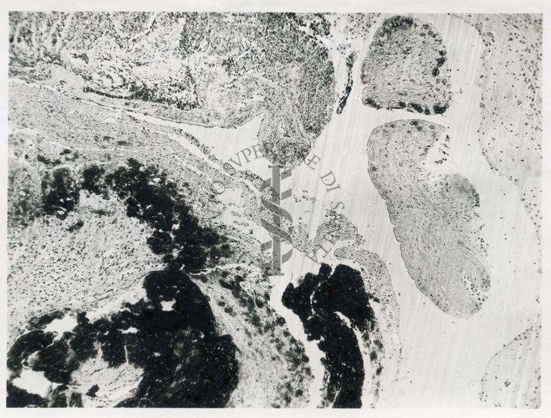 Necrosi nell'omento di un coniglio con Cysticercus pisiformis