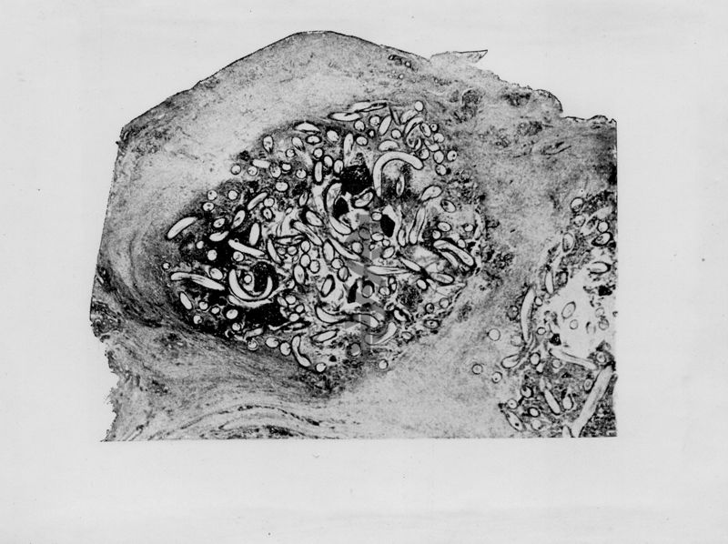 Sezione di nodulo fibroso sottocutaneo causato da Onchocerca volvulus