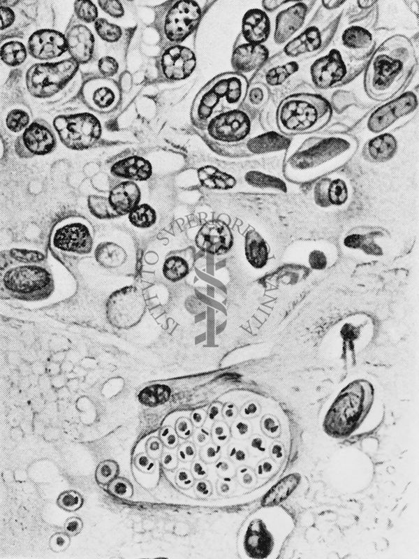 Trypanosoma Cruzi: forme a Leishmania in cervello umano