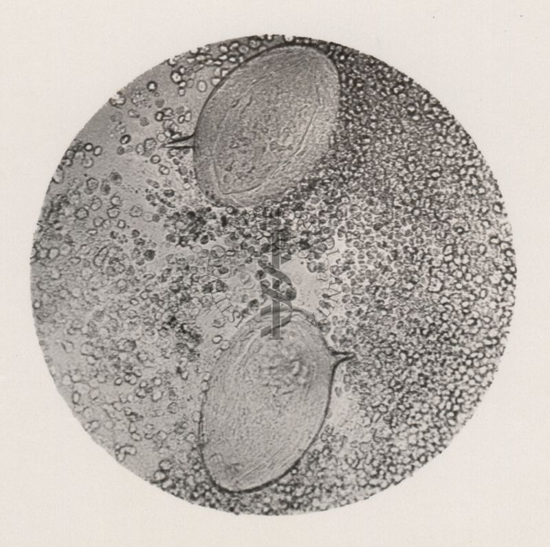 Uova di Schistosoma Mansoni