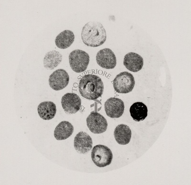 Parassita della febbre della malaria (terzana) forme anulari di diversa grandezza