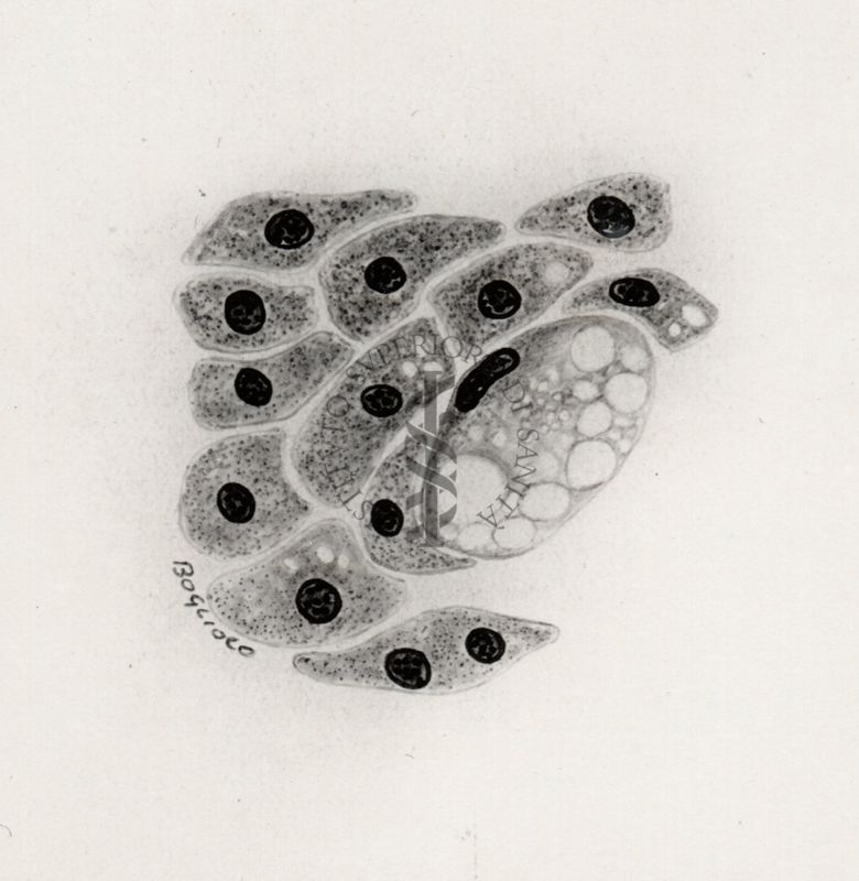 Cellule atipiche in un caso di infestazione del fegato da Cysticercus fasciolaris