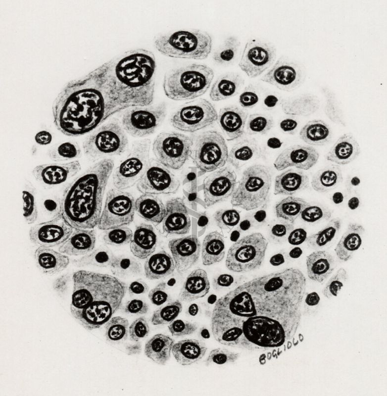 Sarcoma da Cysticercus fasciolaris cellule atipiche